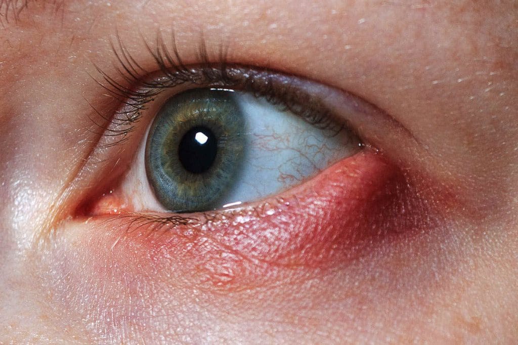 Blefarita Demodex – Infecția invizibilă care provoacă disconfort ocular persistent